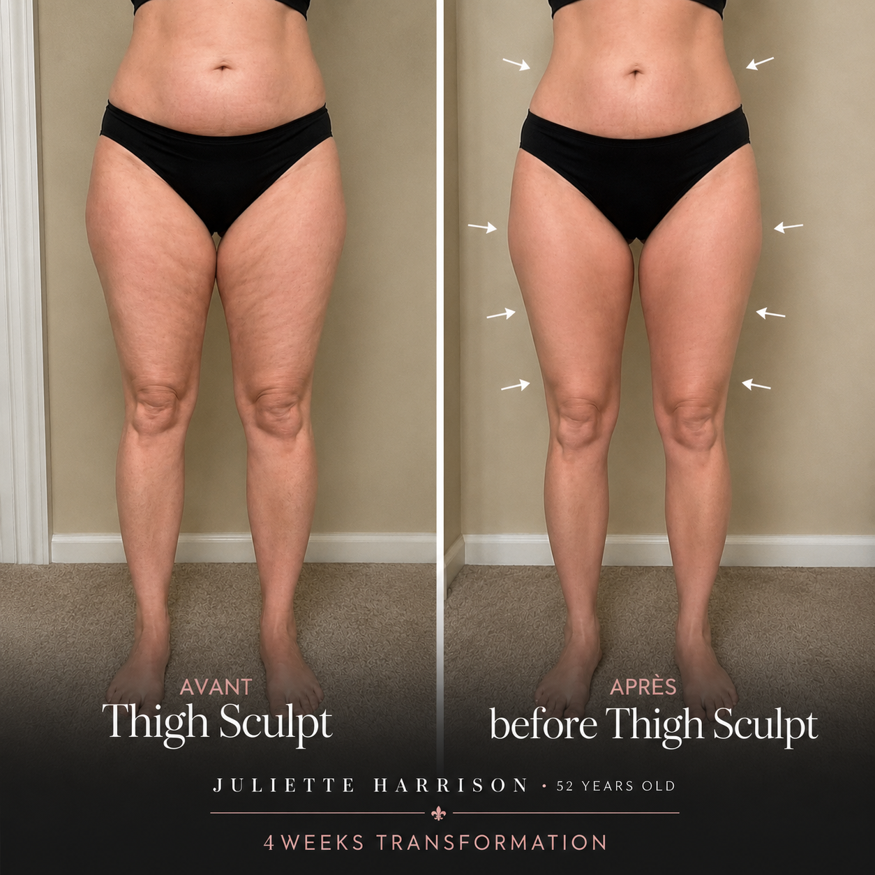 Armelle® Thigh Sculpt